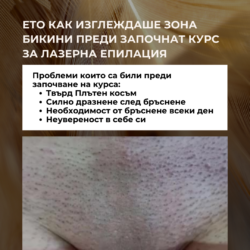 Преди първа процедура за Лазерна Епилация / След първа процедура от Лазерен център Дискрет Лазер Варна