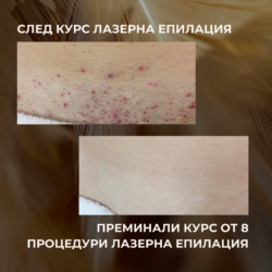 Преди започнат Курс Вашето Бикини може да изглежда така само след 1 Процедура Лазерна Епилация от Лазерен център Дискрет Лазер Варна
