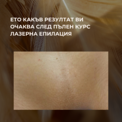 След 8 Процедури Лазерна Епилация Преди започнат курс по лазерна Епилация от Лазерен център Дискрет Лазер Варна