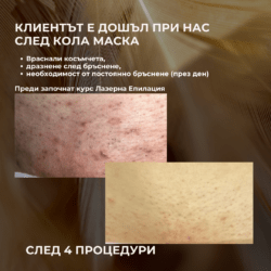 Резултат след 1 процедура Преди от Лазерен център Дискрет Лазер Варна