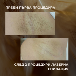 Ето какъв резултат Ви очаква след пълен курс лазерна Епилация от Лазерен център Дискрет Лазер Варна
