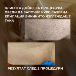 Резултат след 2 Процедури Лзерна епилация от Лазерен център Дискрет Лазер Варна