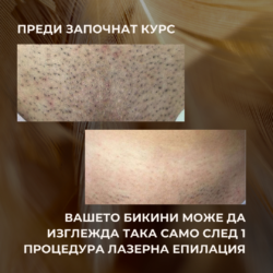 Резултат след 5 Процедури Лазерна Епилация от Лазерен център Дискрет Лазер Варна