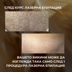 Клиентът е дошъл при нас след кола Маска Враснали косъмчета, дразнене след бръснене, необходимост от постоянно бръснене (през ден) Преди започнат курс Лазерна Епилация След 4 Процедури
